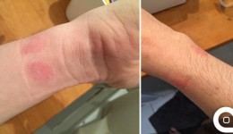 Apple Watch sorgt für Hautausschlag und Apple sieht Schuld bei Kunden